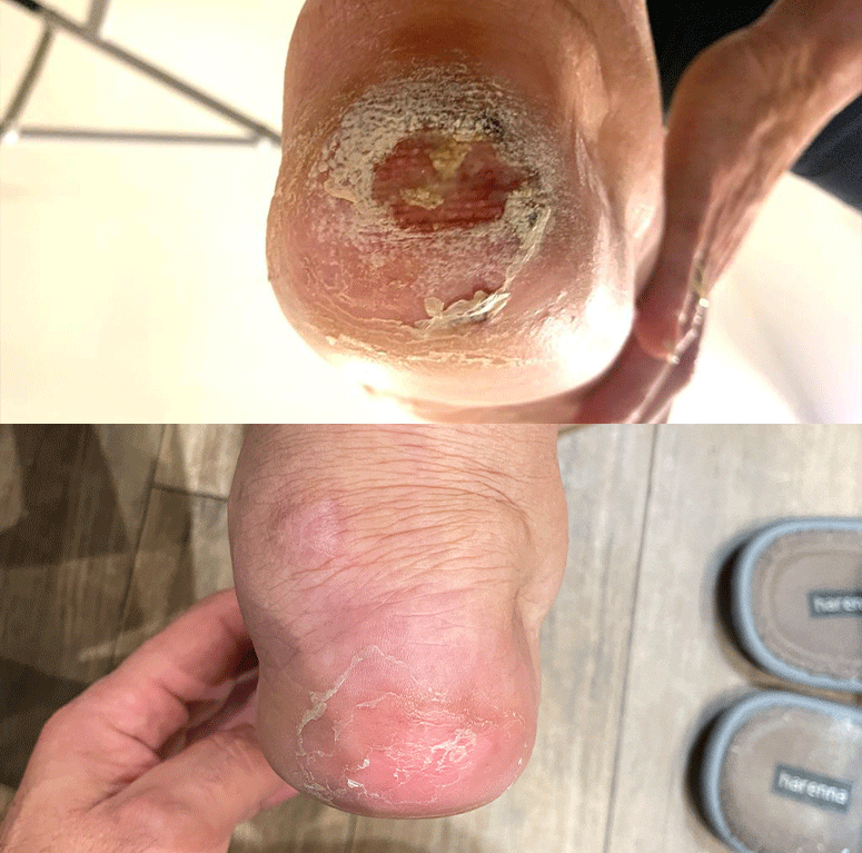 antes-y-despues-ulcera-