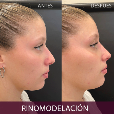 antes-y-despues-labios2